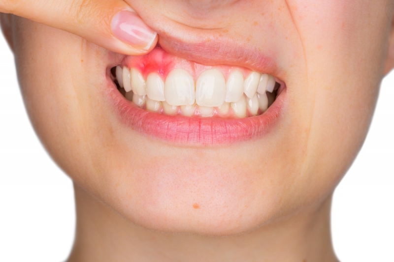 Enfermedades periodonales: causas que lo provocan
