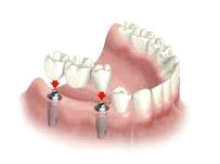 Implante dental de varias piezas :: Clínica Dental Pérez Ballesteros en Salamanca, atención integral de las enfermedades buco-dentales y tratamientos odontológicos