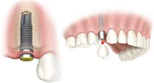 Implante dental de una pieza :: Clínica Dental Pérez Ballesteros en Salamanca, atención integral de las enfermedades buco-dentales y tratamientos odontológicos