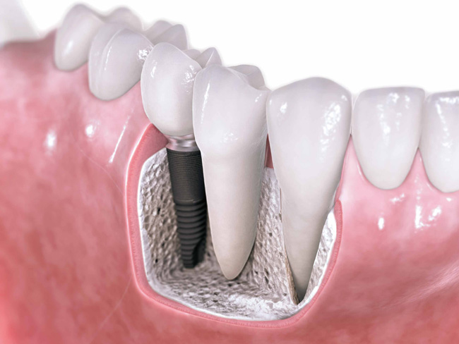 Implante dental :: Clínica Dental Pérez Ballesteros en Salamanca, atención integral de las enfermedades buco-dentales y tratamientos odontológicos