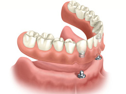 Implante dental de toda la dentadura :: Clínica Dental Pérez Ballesteros en Salamanca, atención integral de las enfermedades buco-dentales y tratamientos odontológicos